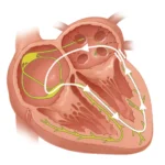 Síndromes de Preexcitación