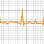 Diagnóstico de la fibrilación atrial