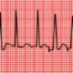 Taquicardia atrial