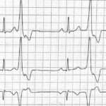 Latidos ventriculares prematuros