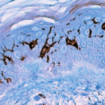 ¿Qué son las Células de Langerhans?