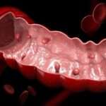 ¿Qué son los pólipos del colon?