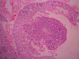 Poliposis adenomatosa familiar Poliposis adenomatosa familiar