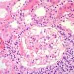 Enfermedad tubulointersticial crónica