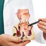 Tratamiento de la enfermedad hemorroidal