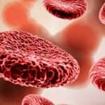 Anemia asociada a enfermedades crónicas