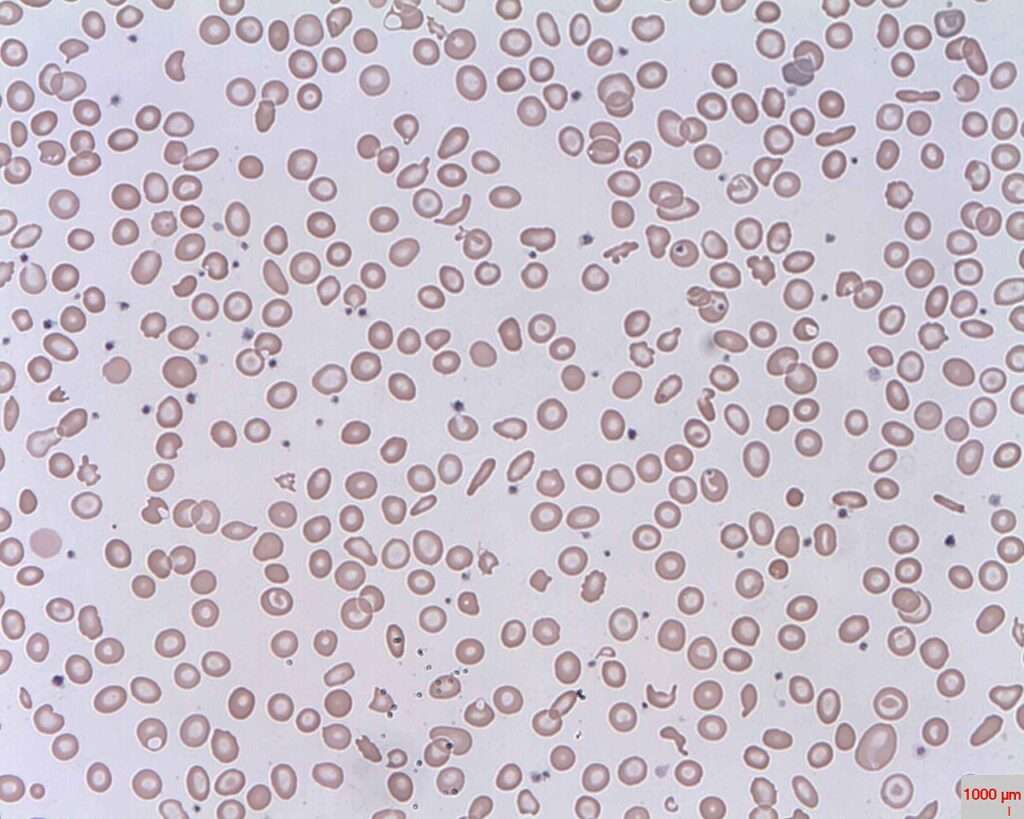 Clasificación de las anemias hemolíticas