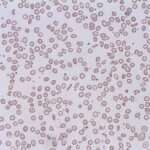 Clasificación de las anemias hemolíticas