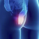 Infecciones anorrectales