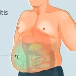 Diagnóstico de ascitis refractaria