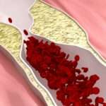 Enfermedad oclusiva de la aorta y las arterias ilíacas comunes