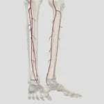 Enfermedad oclusiva de la arteria tibial y del pie
