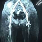 Oclusión arterial aguda de una extremidad