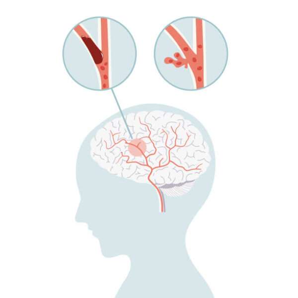 Enfermedad cerebrovascular oclusiva