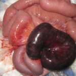 Isquemia mesentérica (Angina intestinal)