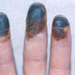 TROMBOANGEÍTIS OBLITERANTE (Enfermedad de Buerger)