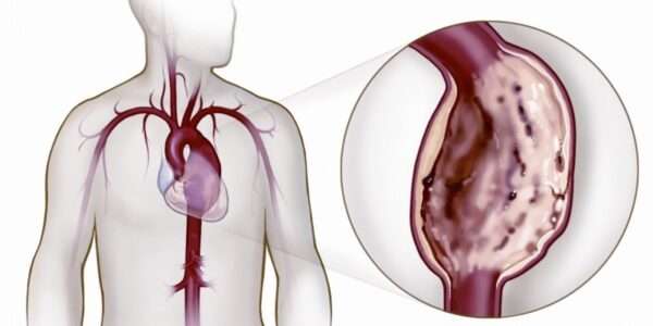 Aneurismas del aorta torácica