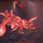 Combinación de Anemia Falciforme y Talasemia