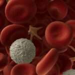 Anemia hemolítica autoinmune