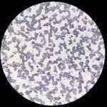 Enfermedad por aglutininas frías