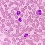 Neutropenia