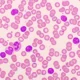 Leucemia linfocítica crónica