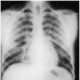 Lesión pulmonar aguda relacionada con la transfusión