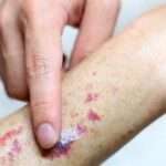 Trombocitopenia debida a fármacos