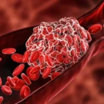 Prevención de la enfermedad tromboembólica venosa