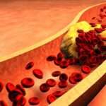 ¿A que pacientes se les ofrece la terapia anticoagulante para prevenir la enfermedad tromboembólica venosa?