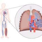 Estratificación de riesgos para la terapia anticoagulante inicial adecuada para la enfermedad tromboembólica venosa