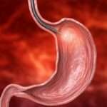 Causas de sangrado del tubo digestivo alto