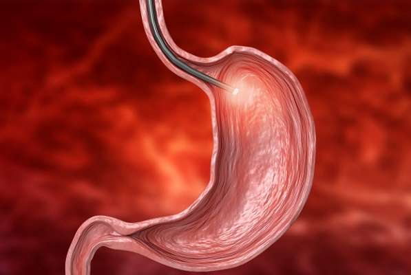 Causas de sangrado del tubo digestivo alto