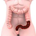 Evaluación y manejo de pacientes con hemorragia del tubo digestivo bajo