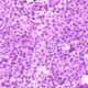 Esofagitis eosinofílica