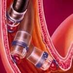 Prevención del resangrado de varices esofágicas