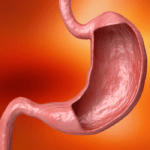 ¿Qué es la Gastritis asociada a anemia perniciosa?