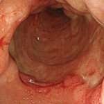 Gastritis flemonosa