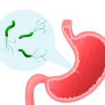 Úlceras asociadas a Helicobacter pylori