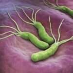 Tratamiento de las úlceras asociadas a Helicobacter pylori