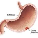 Úlcera gastroduodenal perforada