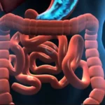 Síndrome del intestino corto