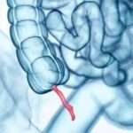 Apendicitis aguda