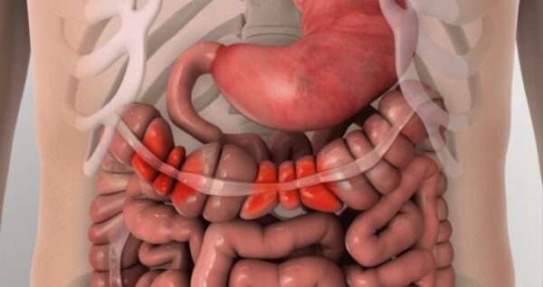 Patogénesis del Síndrome del intestino irritable
