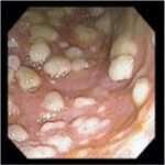 Colitis asociada a antibióticos
