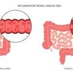 ¿Qué es la enfermedad inflamatoria intestinal?