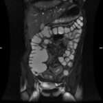 Exámenes diagnósticos para la enfermedad de Crohn