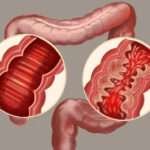 Tratamiento de la enfermedad de Crohn activa