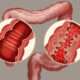 Tratamiento de la enfermedad de Crohn activa