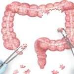 Indicaciones de cirugía para pacientes con enfermedad de Crohn
